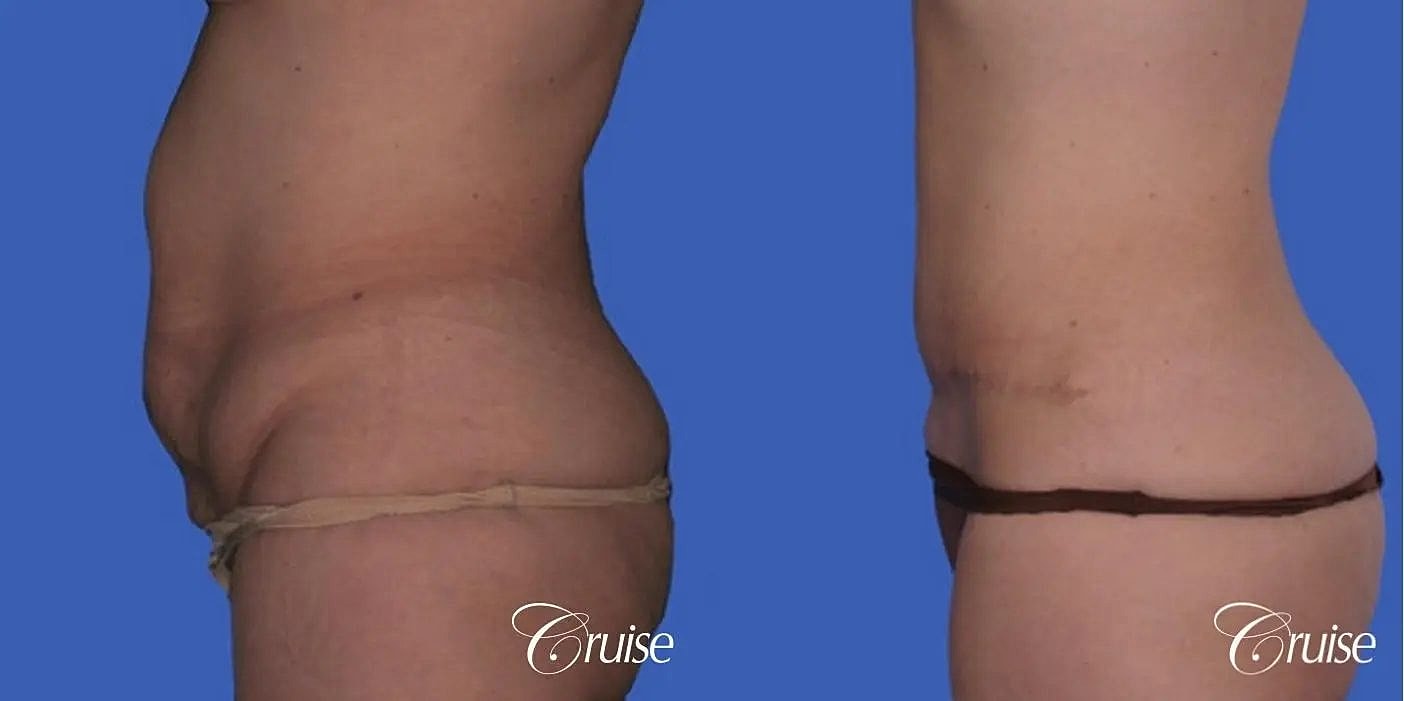 Tummy Tuck Before & After