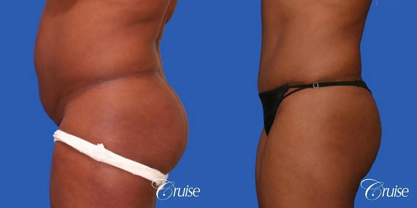Tummy Tuck Before & After