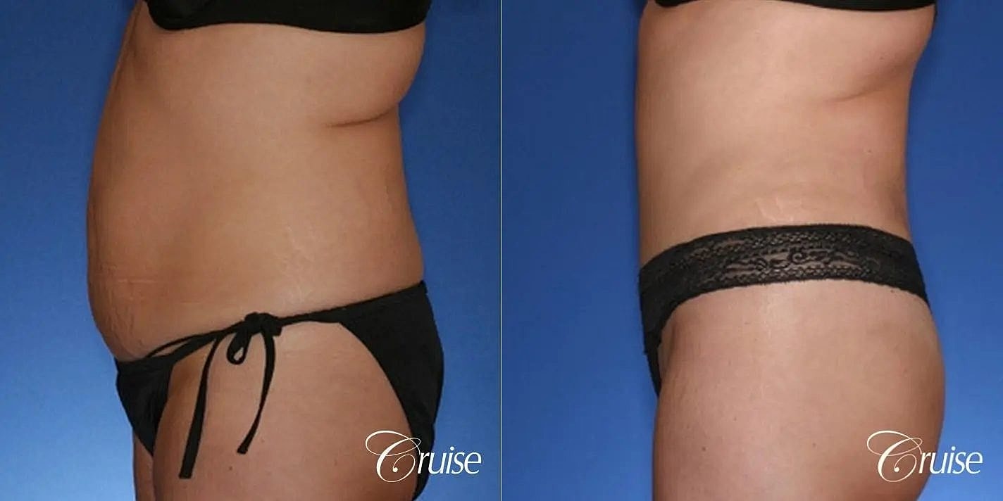 Tummy Tuck Before & After