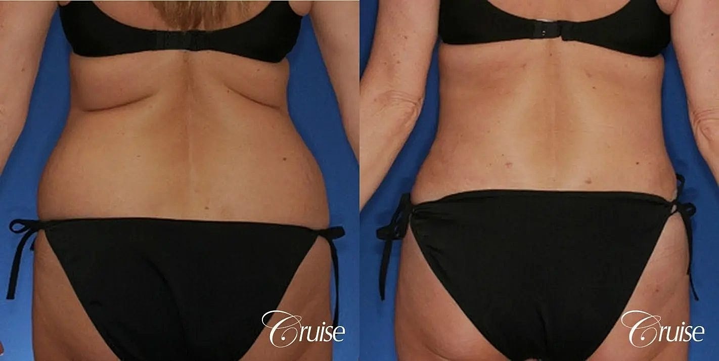 Tummy Tuck Before & After