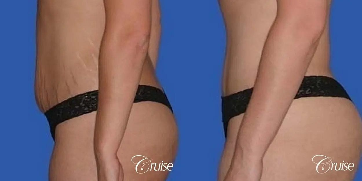 Tummy Tuck Before & After