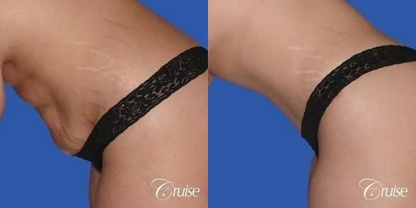 Tummy Tuck Before & After