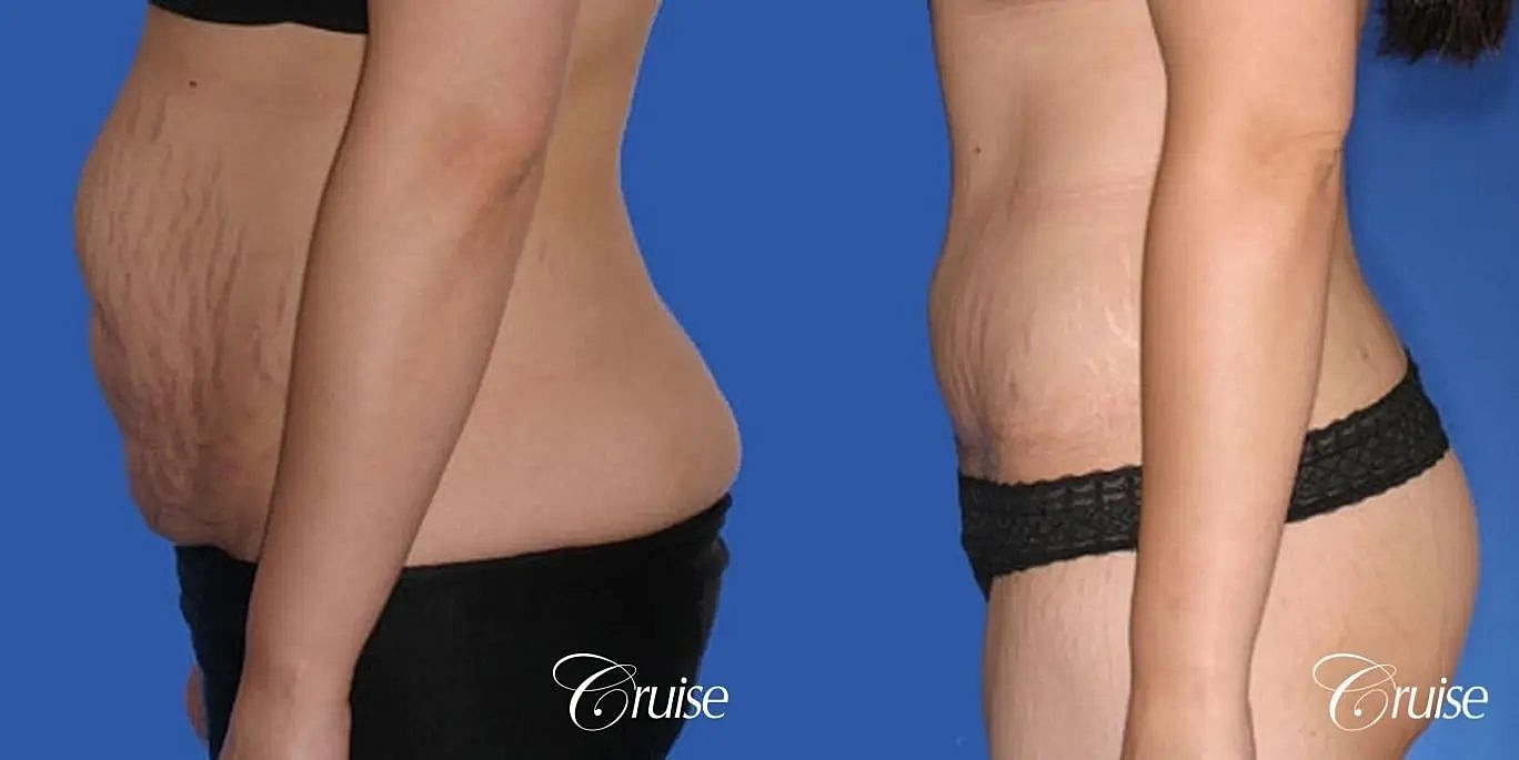 Tummy Tuck Before & After