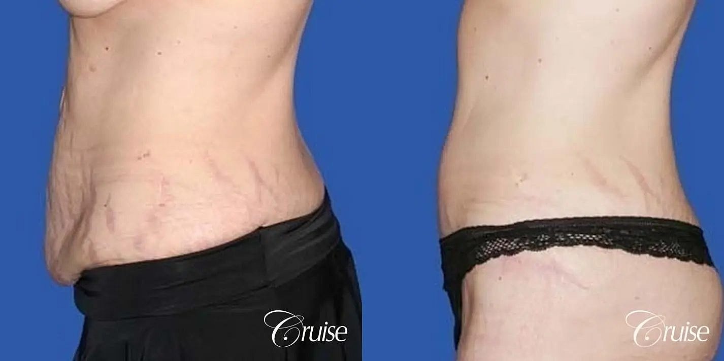 Tummy Tuck Before & After
