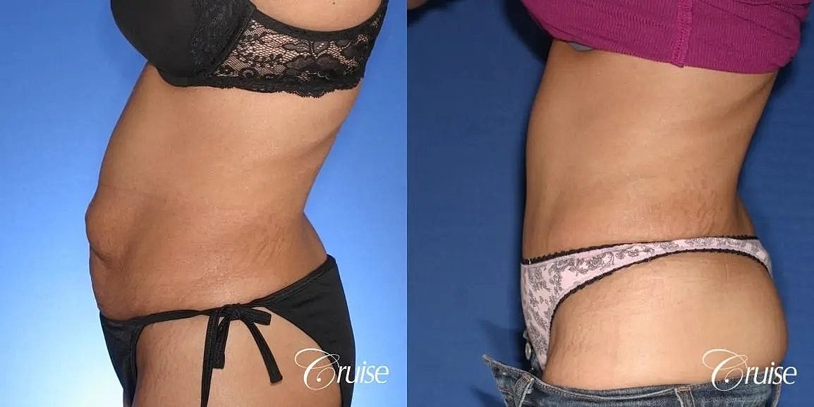 Tummy Tuck Before & After