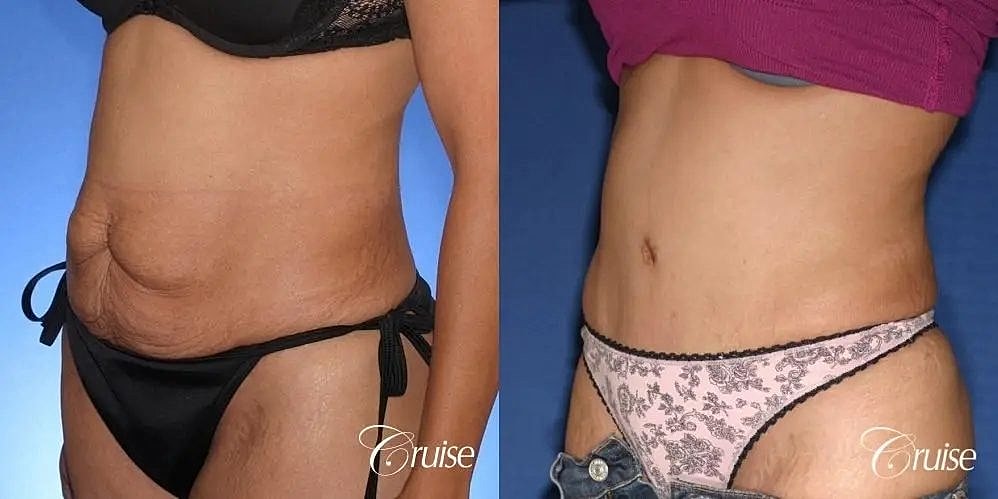 Tummy Tuck Before & After