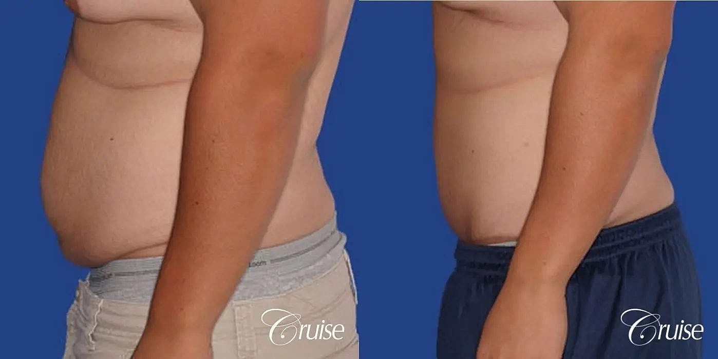 Tummy Tuck Before & After