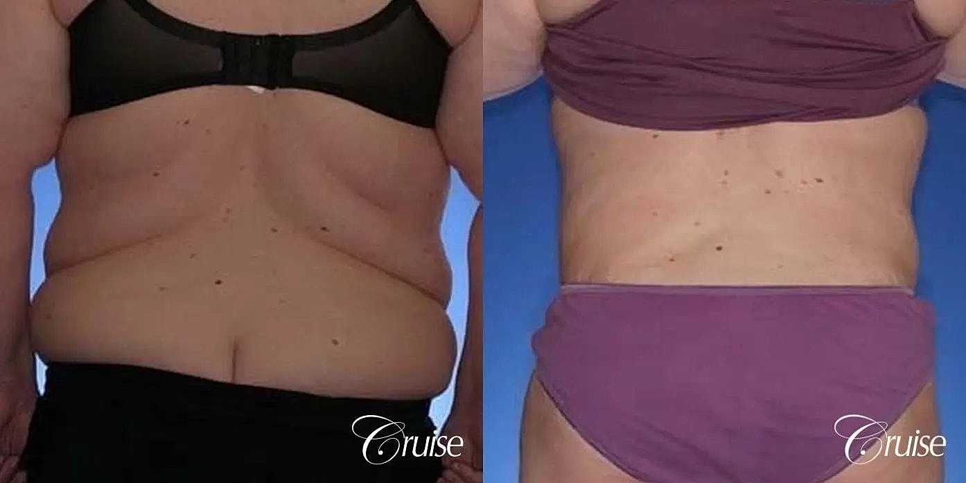 Tummy Tuck Before & After