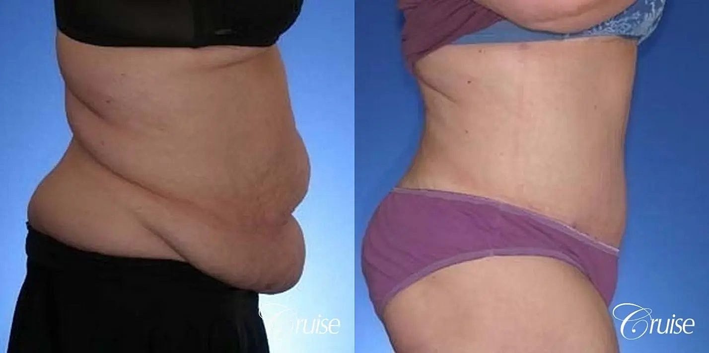 Tummy Tuck Before & After