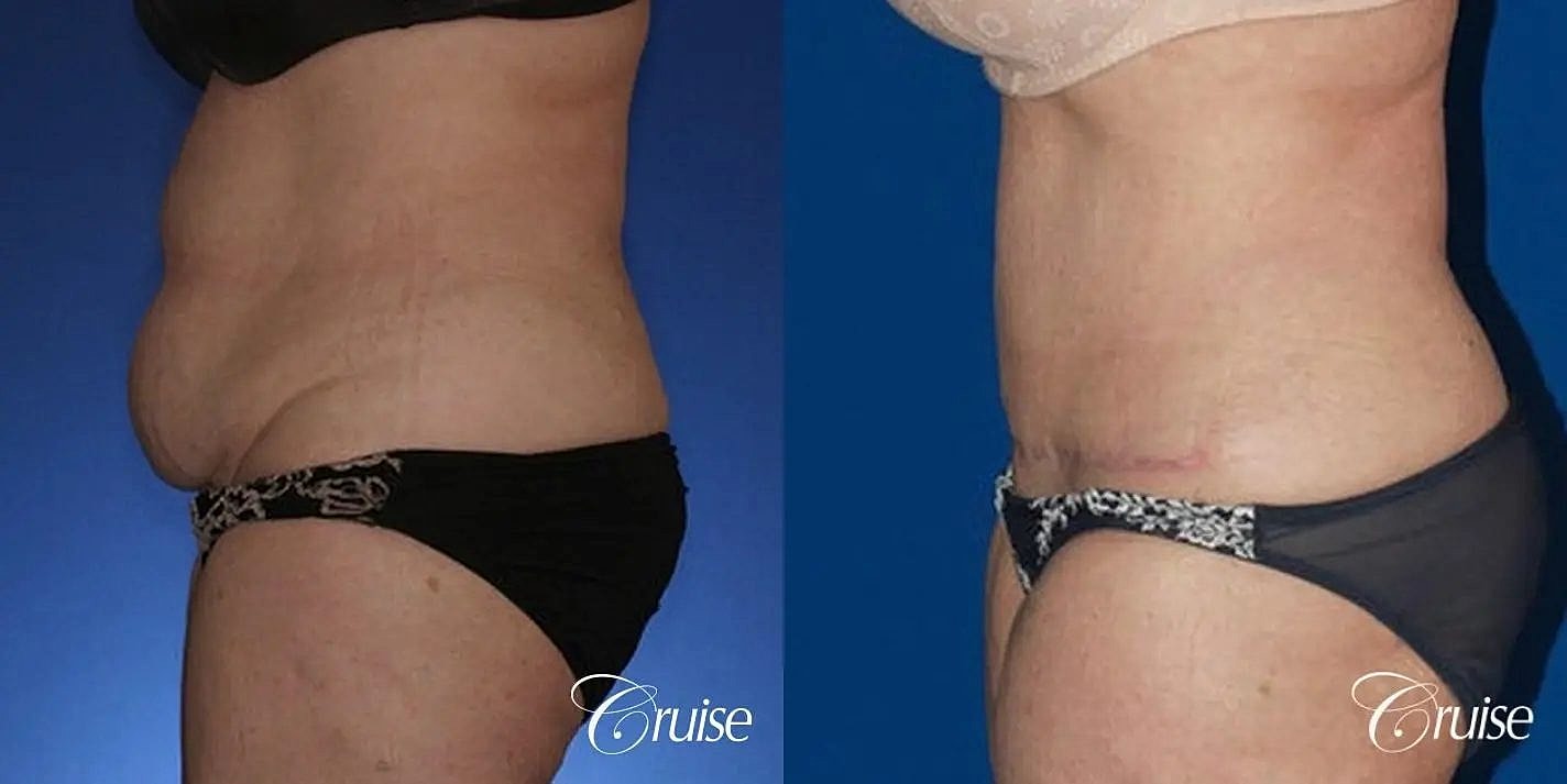 Tummy Tuck Before & After