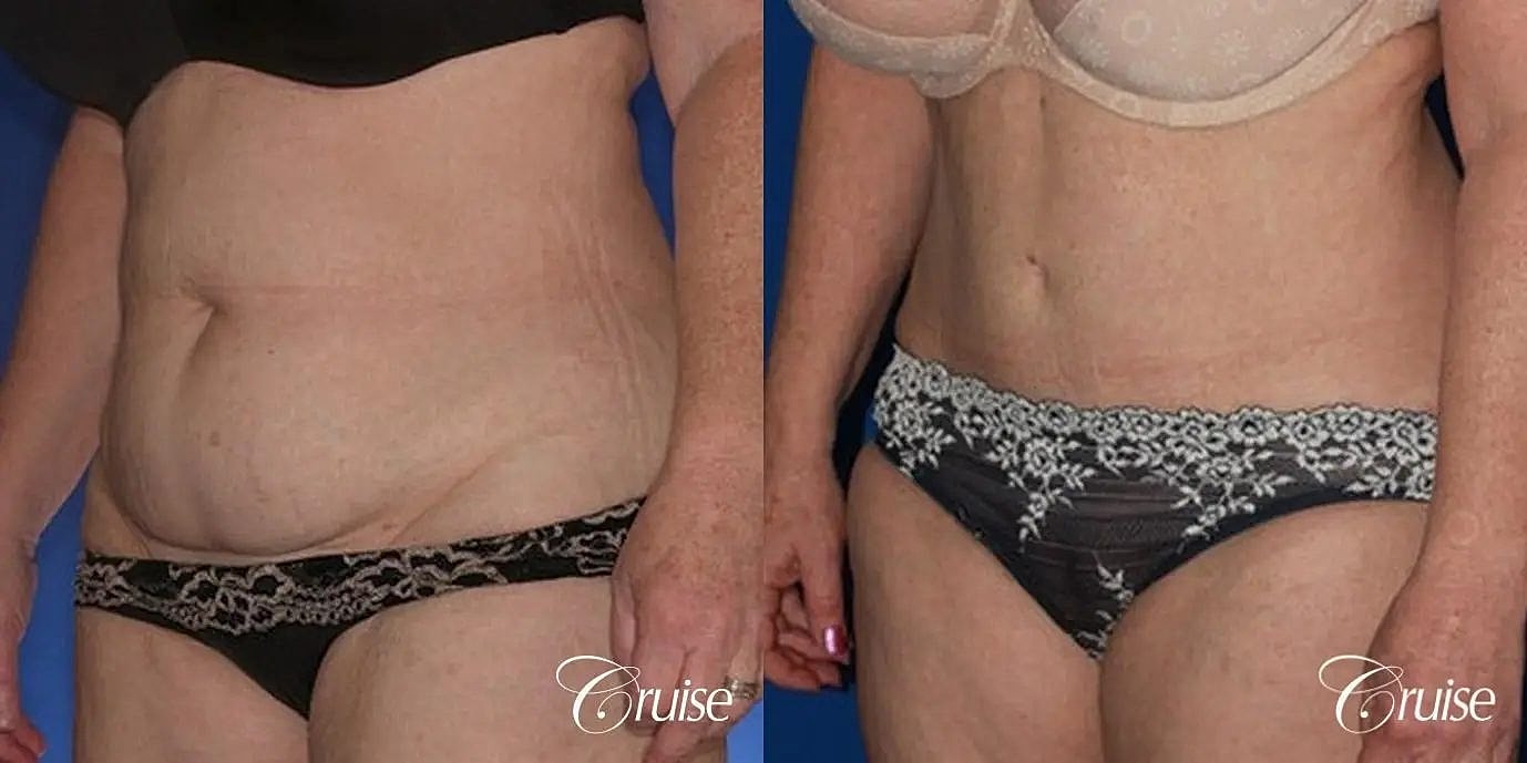 Tummy Tuck Before & After