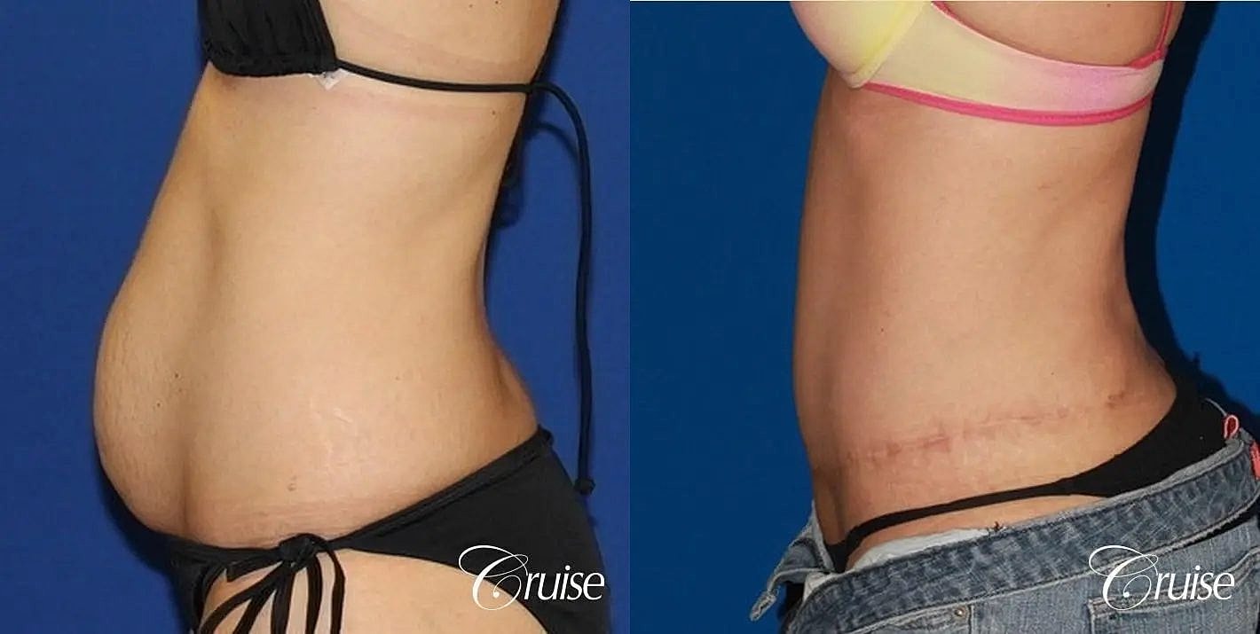Tummy Tuck Before & After
