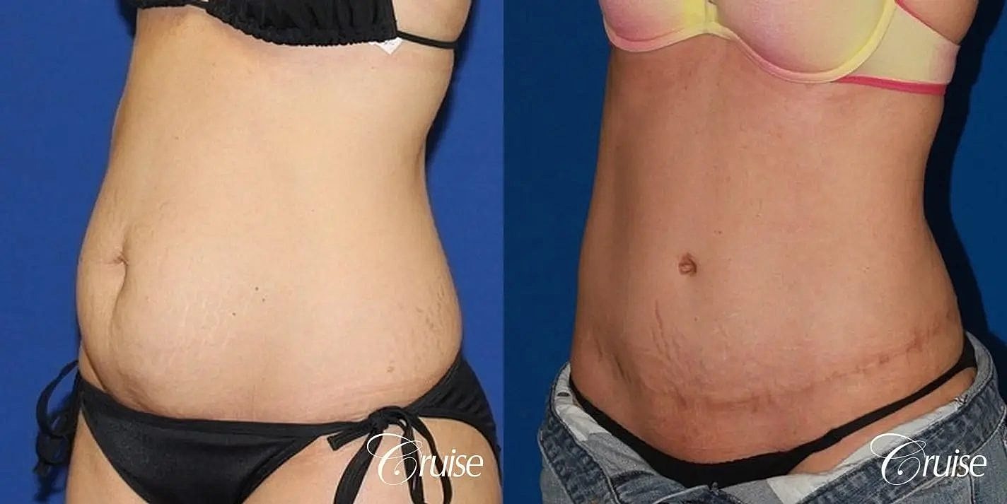 Tummy Tuck Before & After
