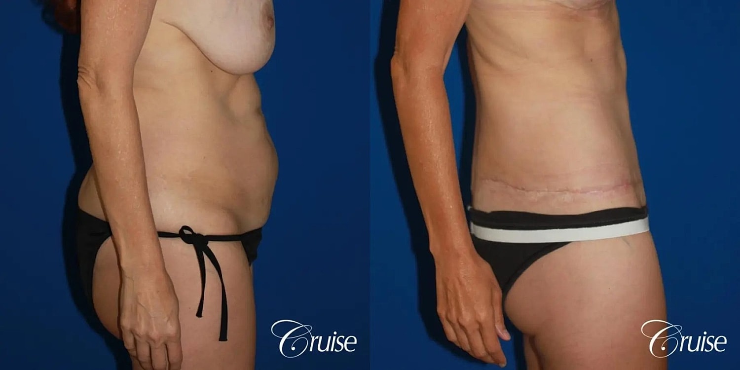 Tummy Tuck Before & After