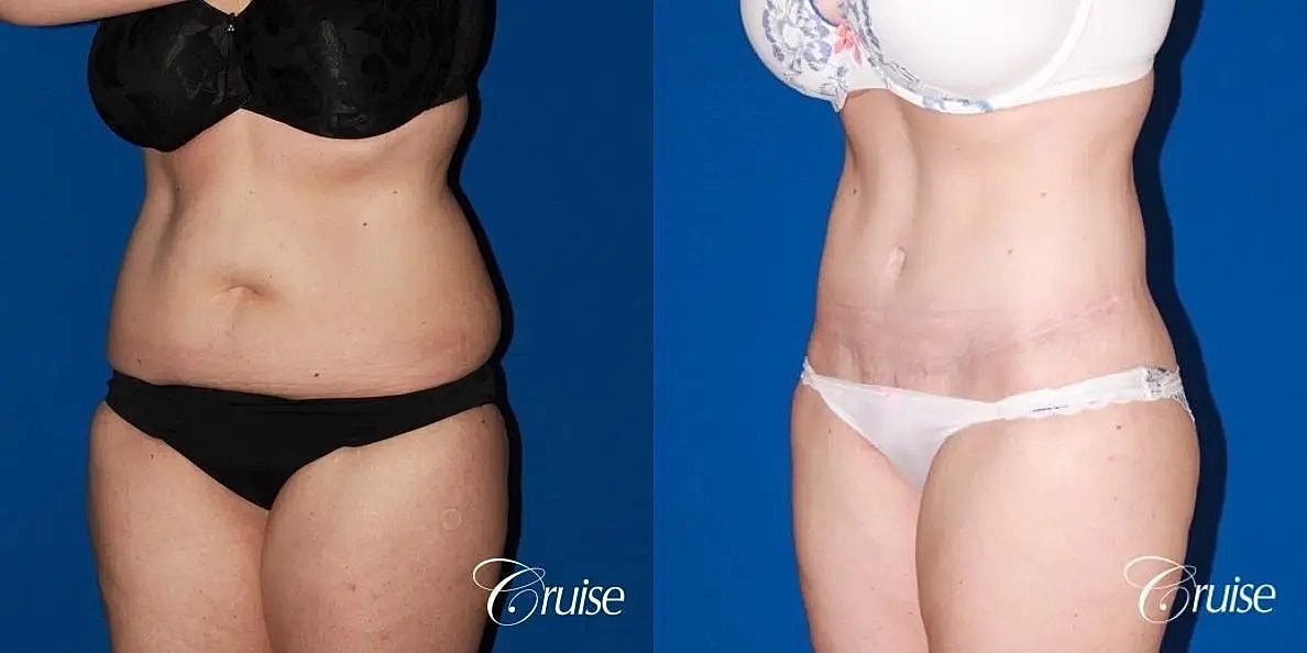 Tummy Tuck Before & After