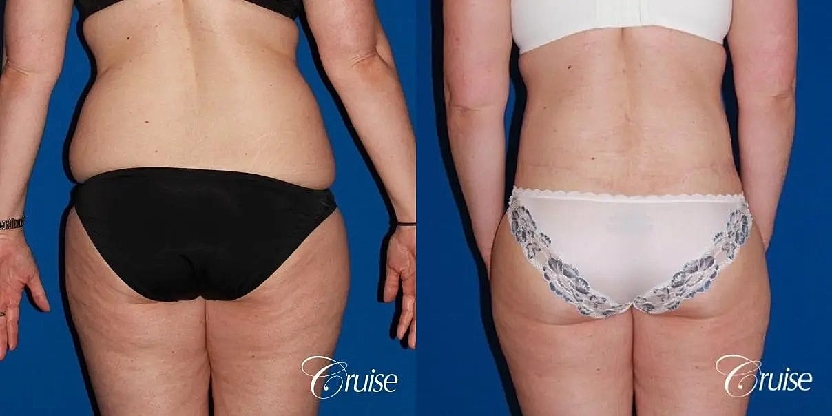 Tummy Tuck Before & After