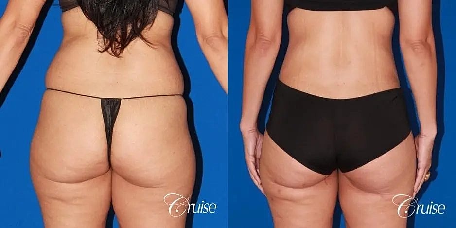 Tummy Tuck Before & After