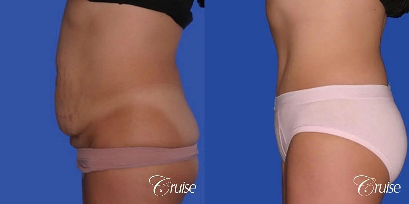 Tummy Tuck Before & After
