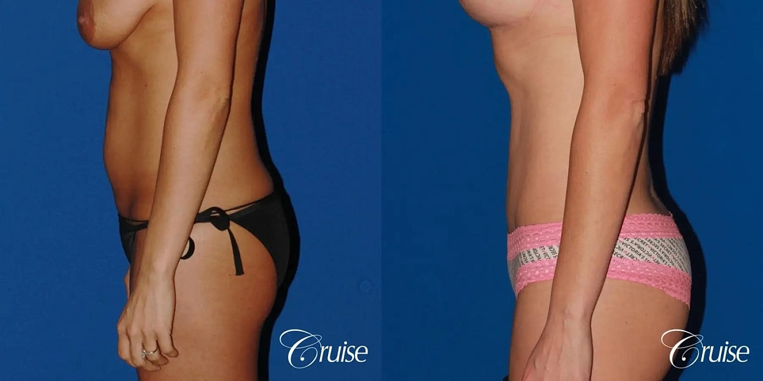 Tummy Tuck Before & After