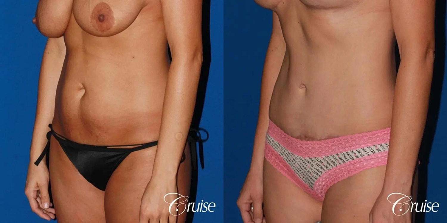 Tummy Tuck Before & After