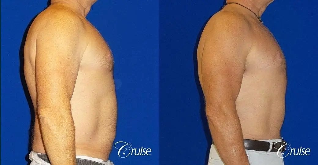 Tummy Tuck Before & After