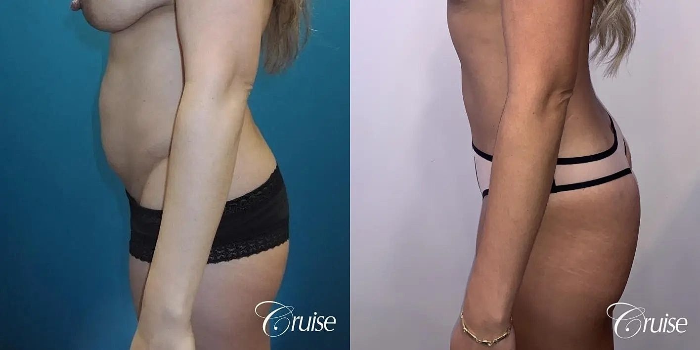 Tummy Tuck Before & After