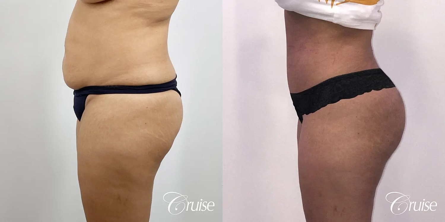 Tummy Tuck Before & After