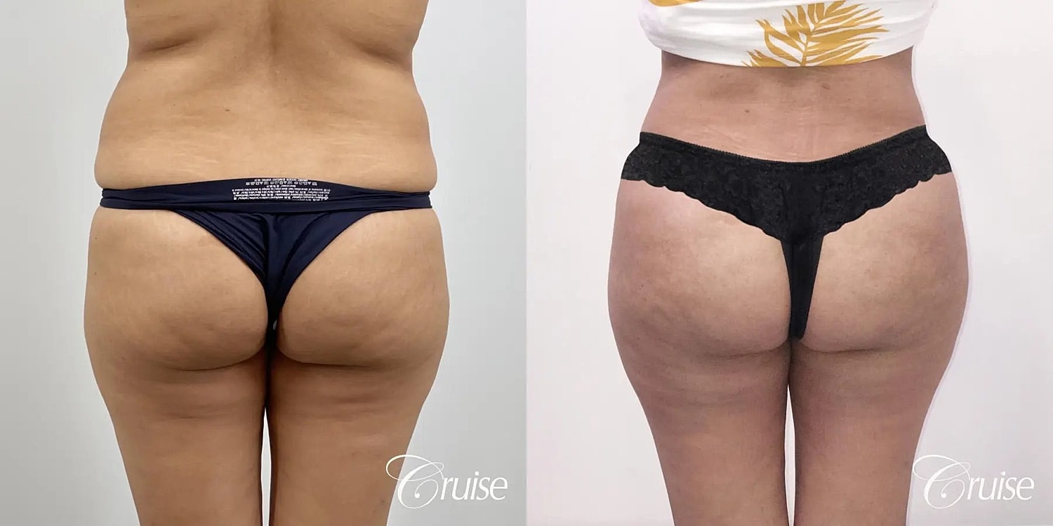 Tummy Tuck Before & After