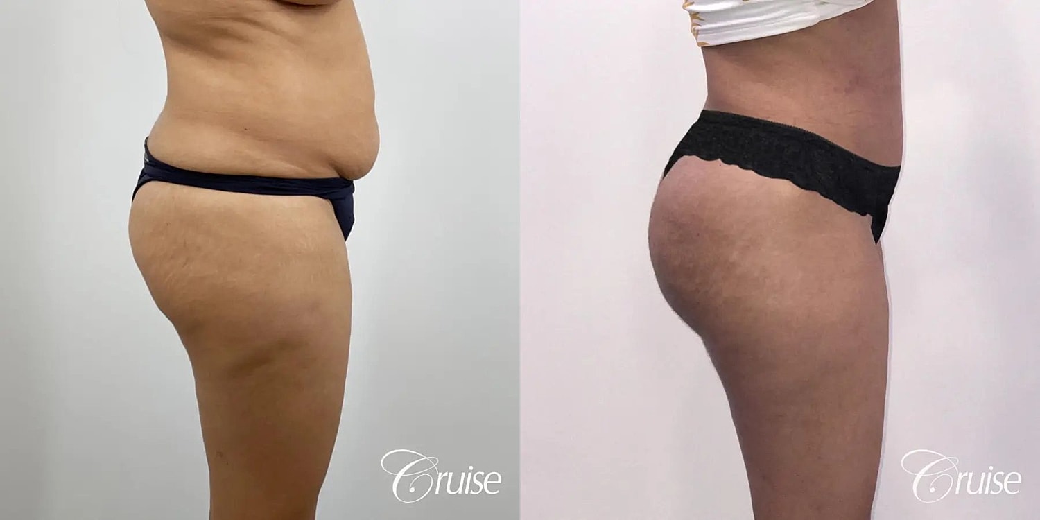 Tummy Tuck Before & After