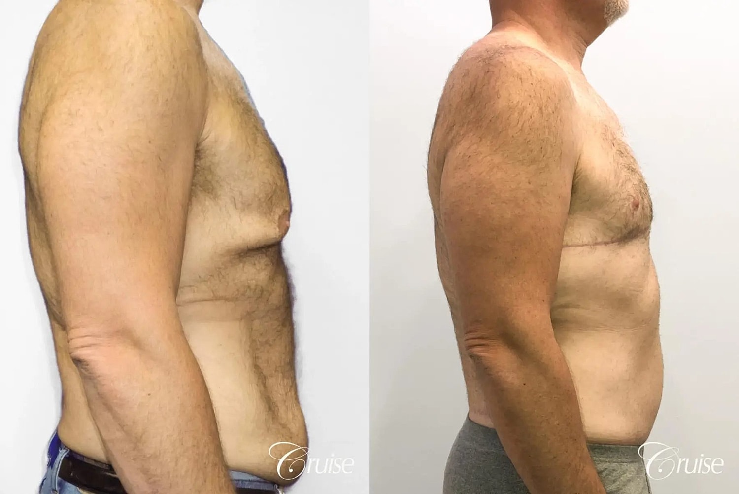 Tummy Tuck Before & After
