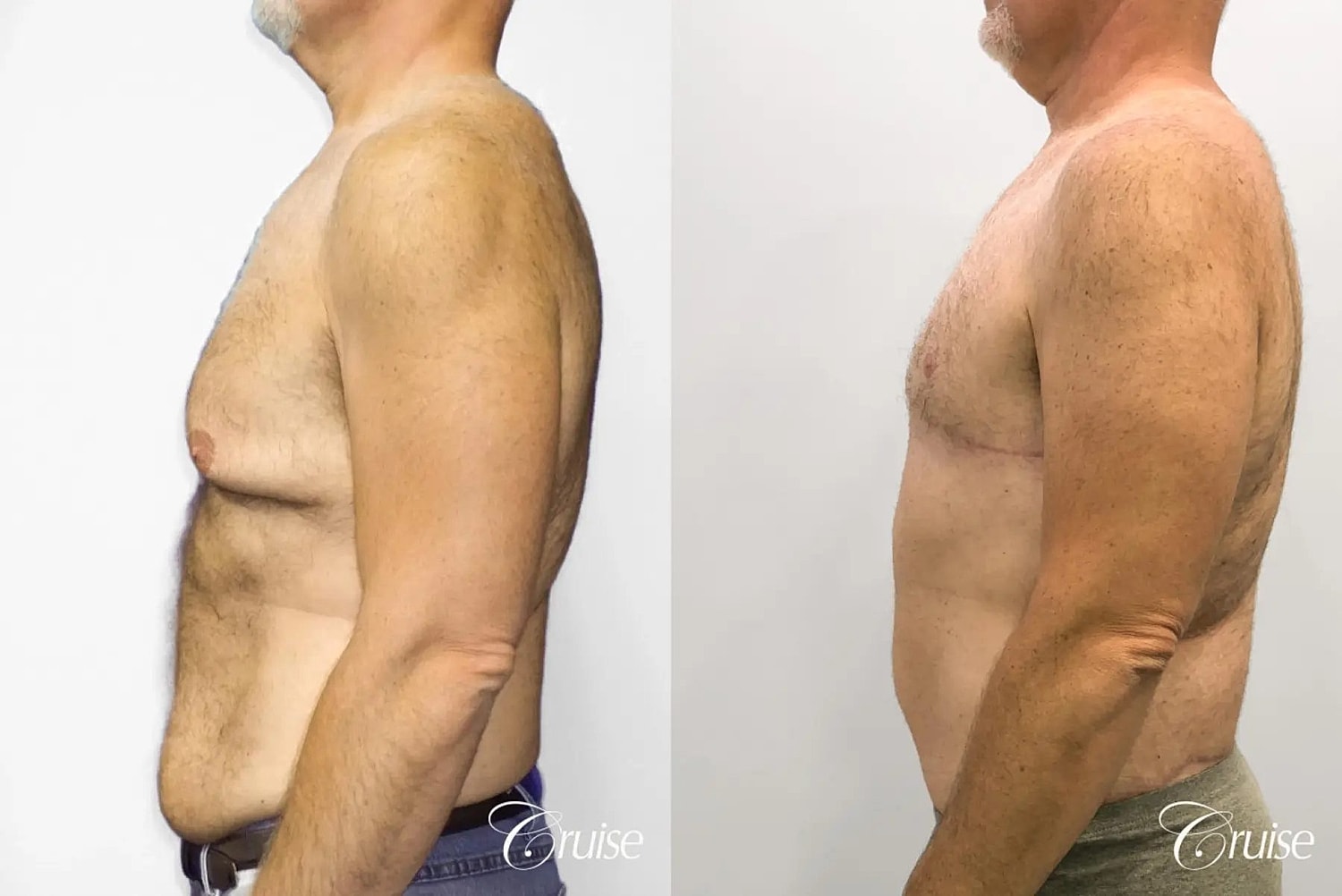 Tummy Tuck Before & After