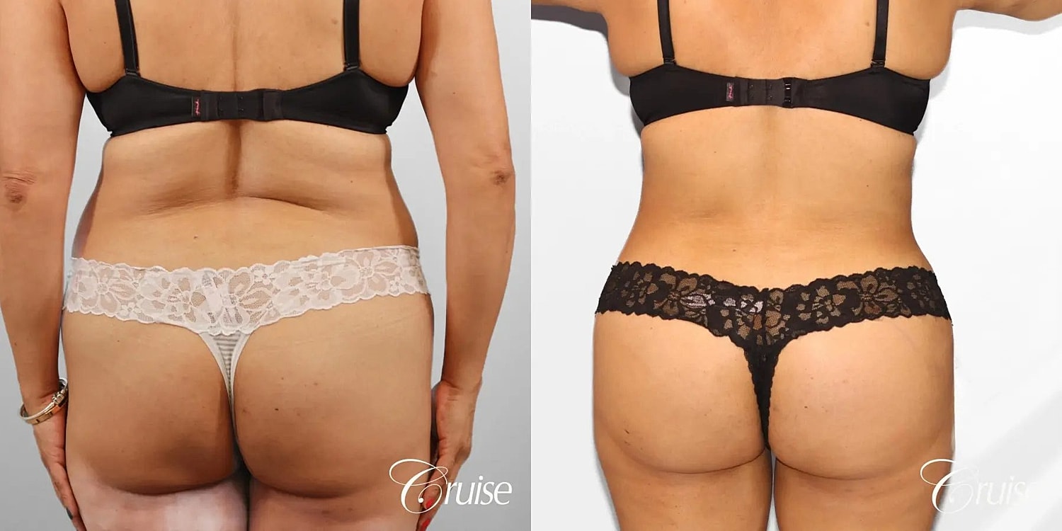 Tummy Tuck Before & After