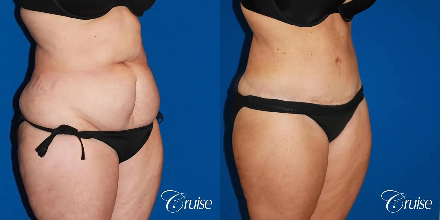Tummy Tuck Before & After