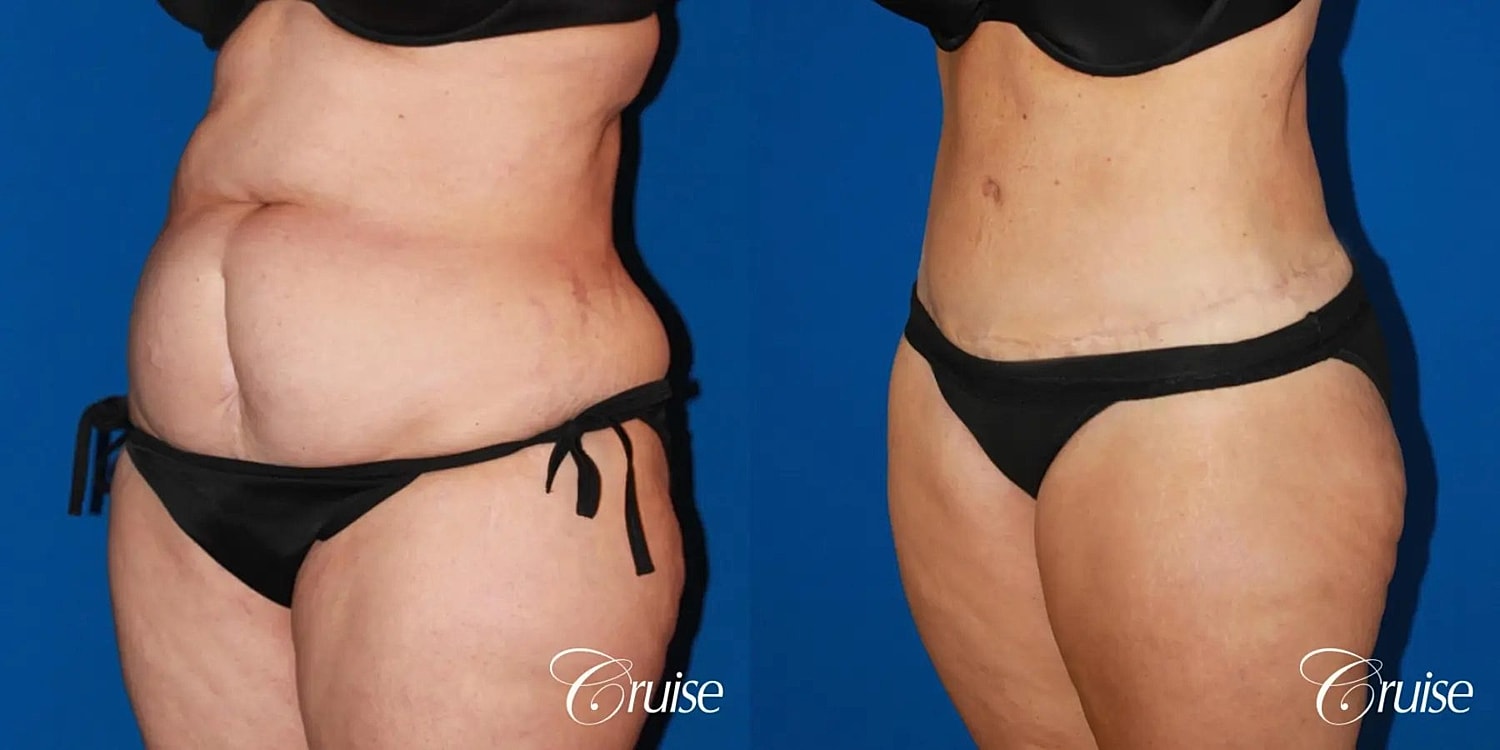 Tummy Tuck Before & After