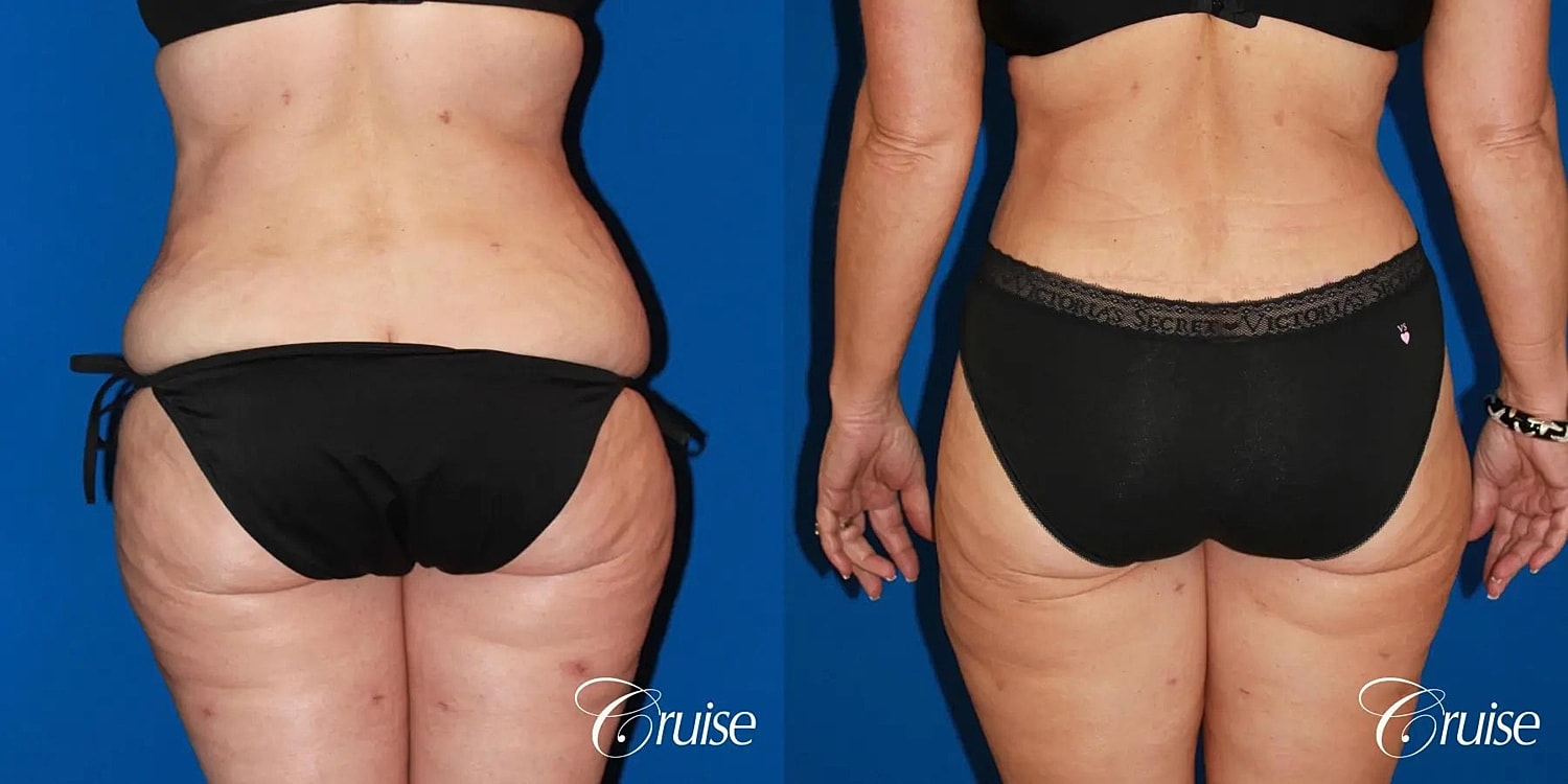 Tummy Tuck Before & After