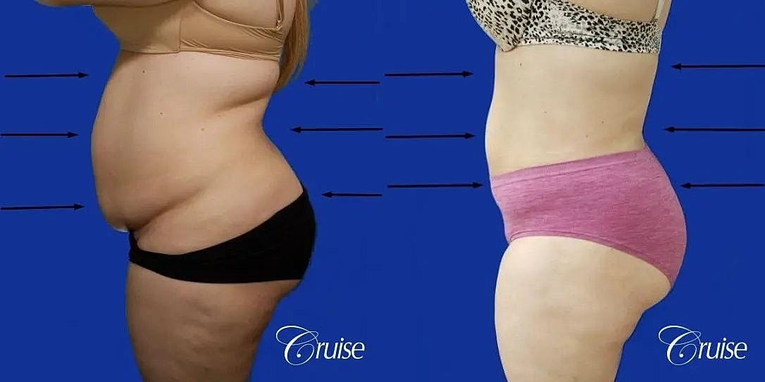 Liposuction Before & After