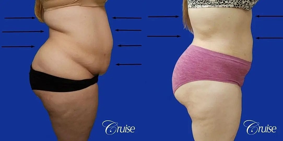 Liposuction Before & After