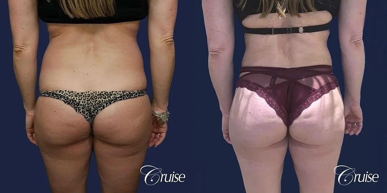 Liposuction Before & After