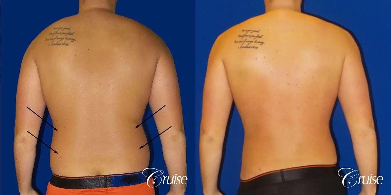 Liposuction Before & After
