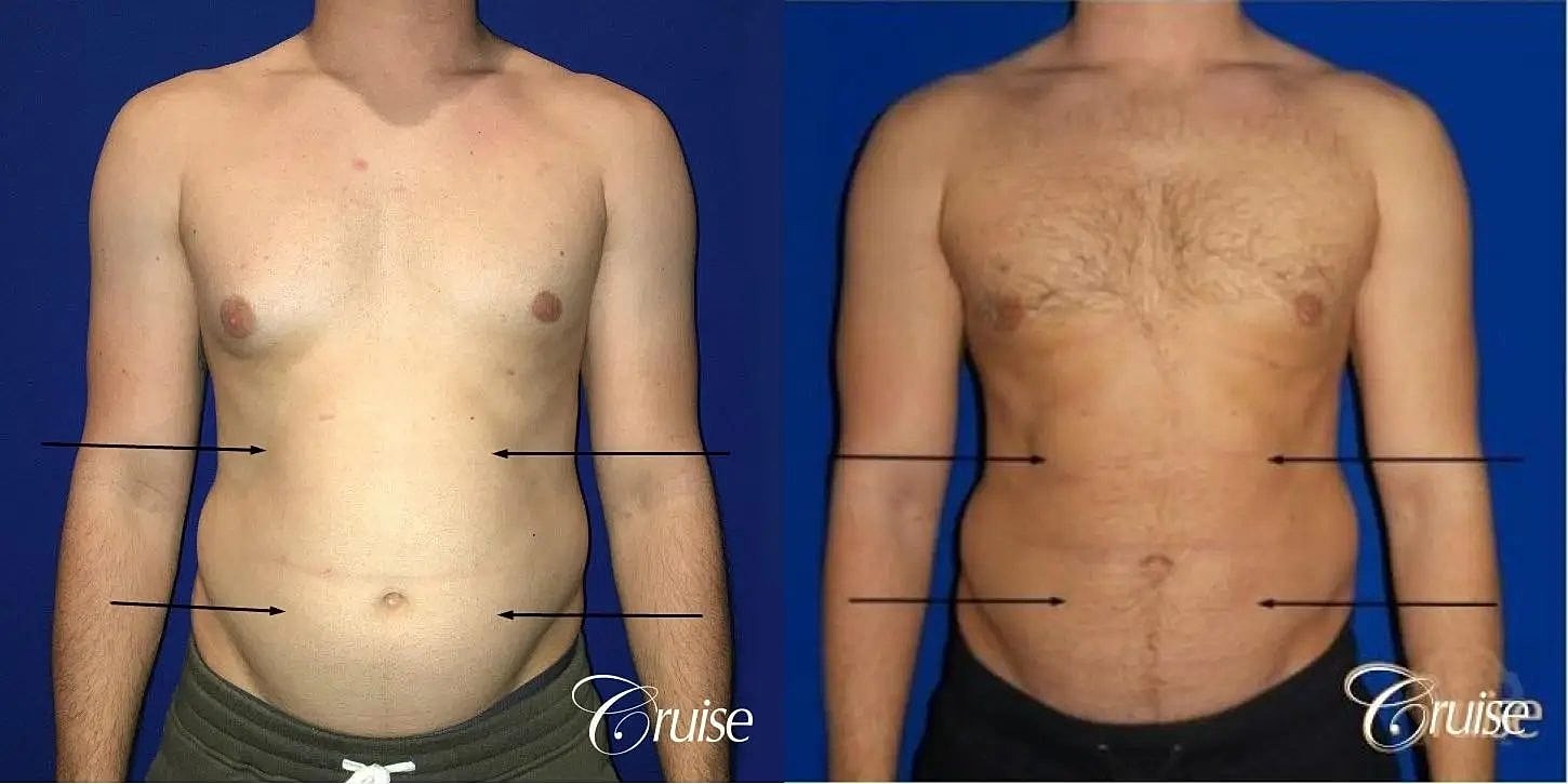 Liposuction Before & After