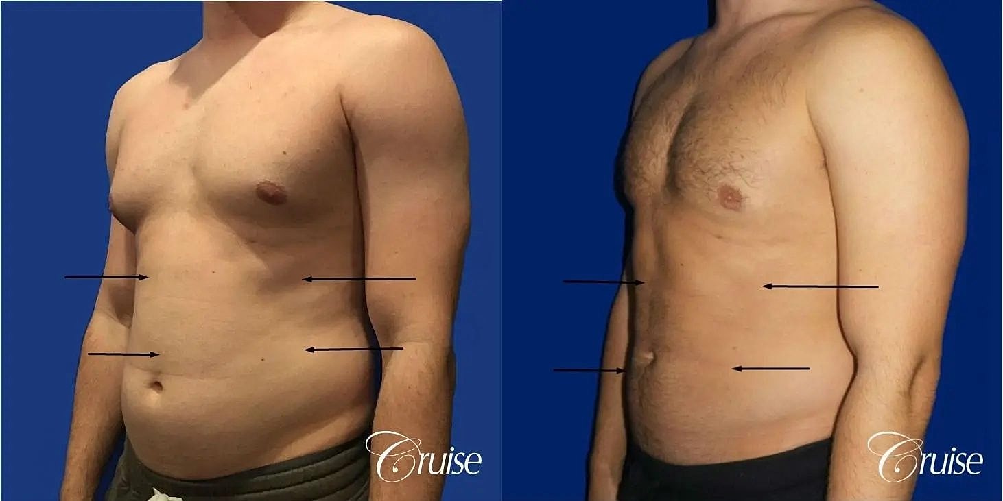 Liposuction Before & After