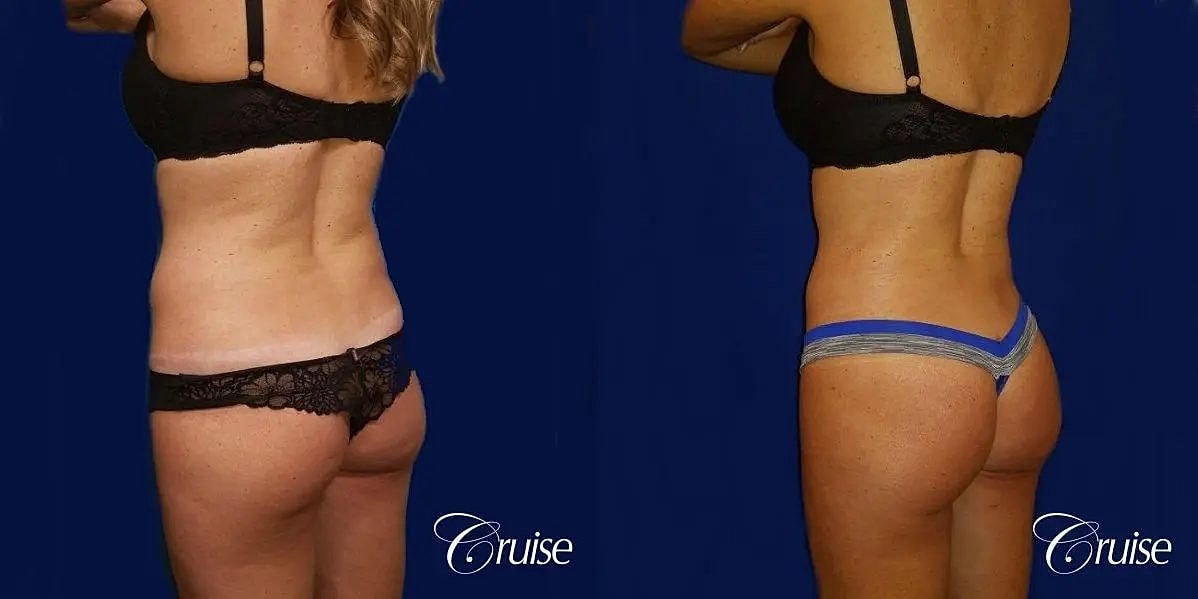 Liposuction Before & After
