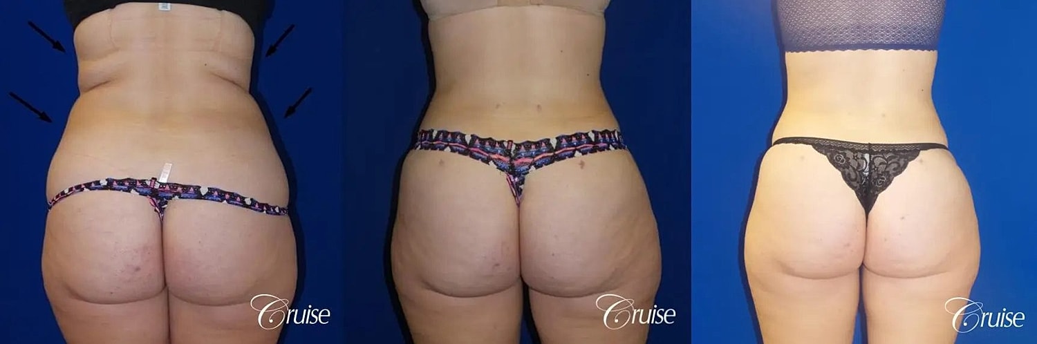 Liposuction Before & After