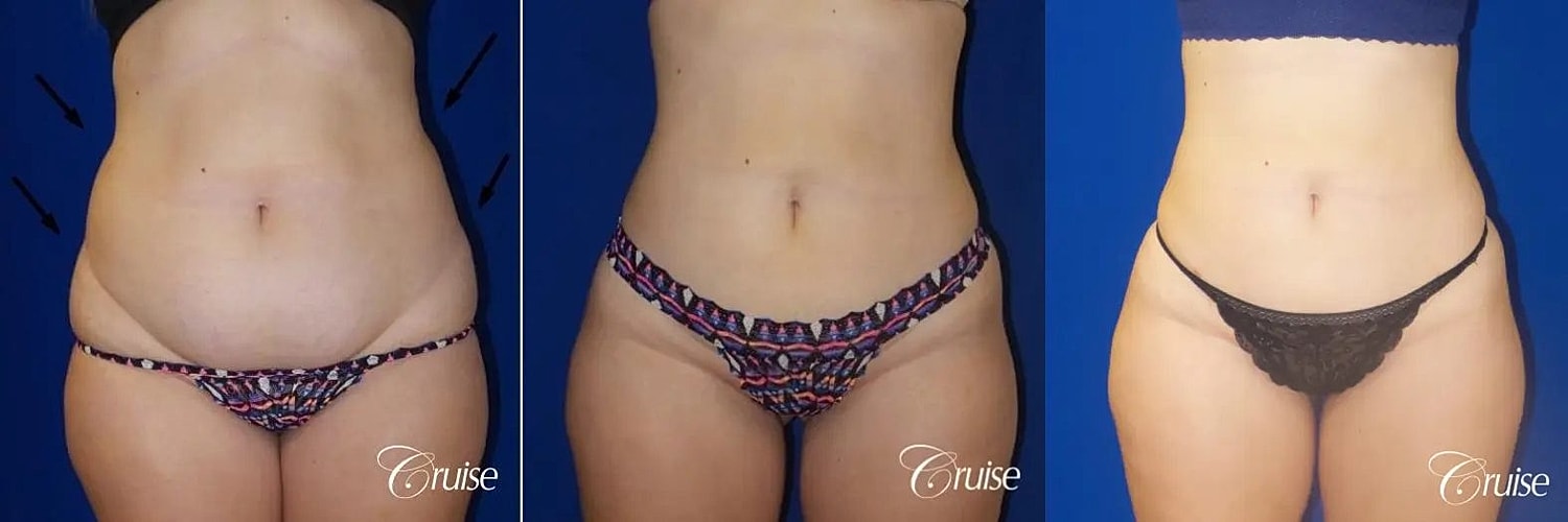 Liposuction Before & After