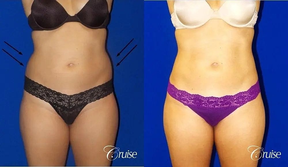 Liposuction Before & After
