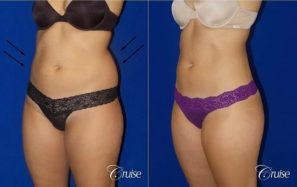 Liposuction Before & After