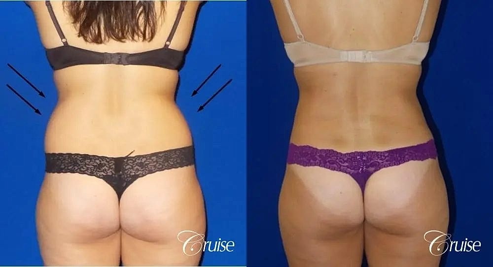 Liposuction Before & After