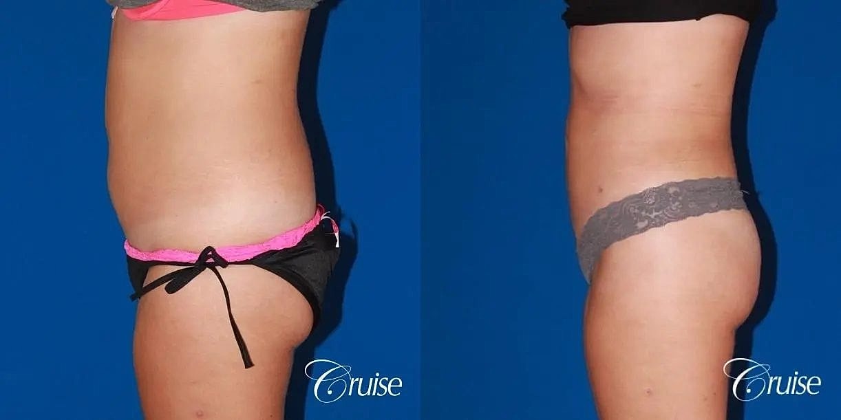 Liposuction Before & After