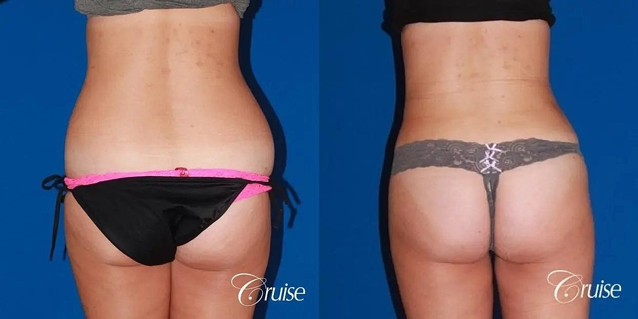 Liposuction Before & After