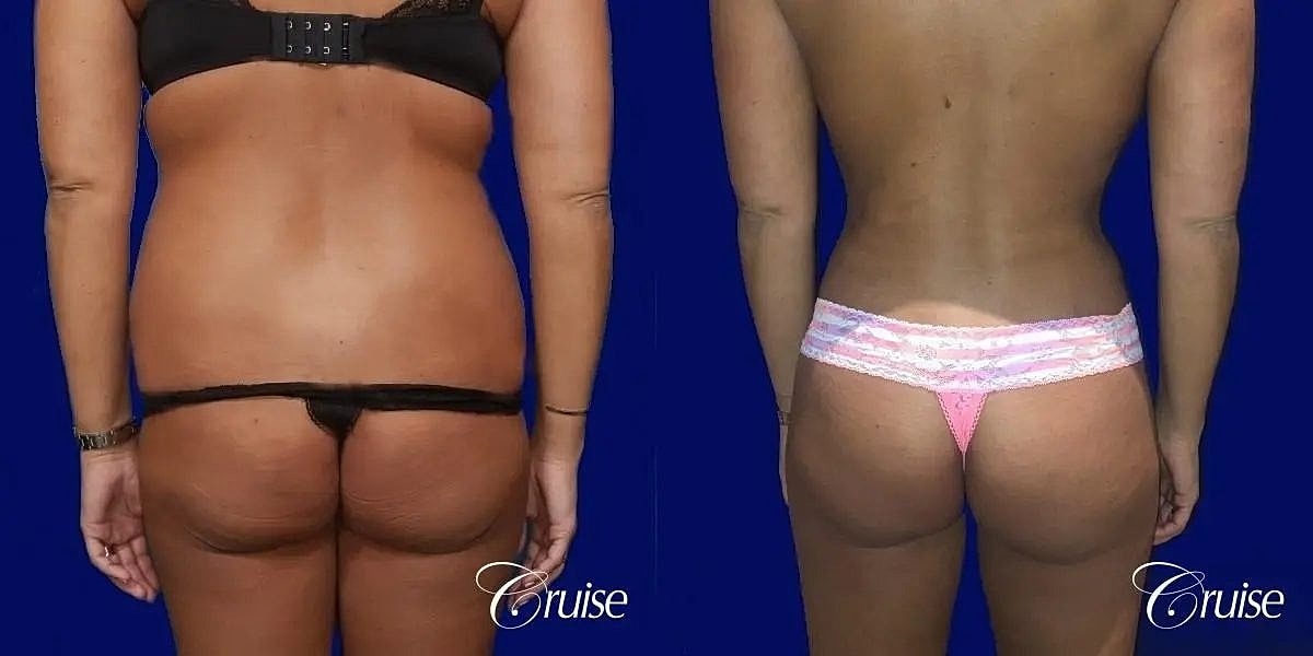 Liposuction Before & After